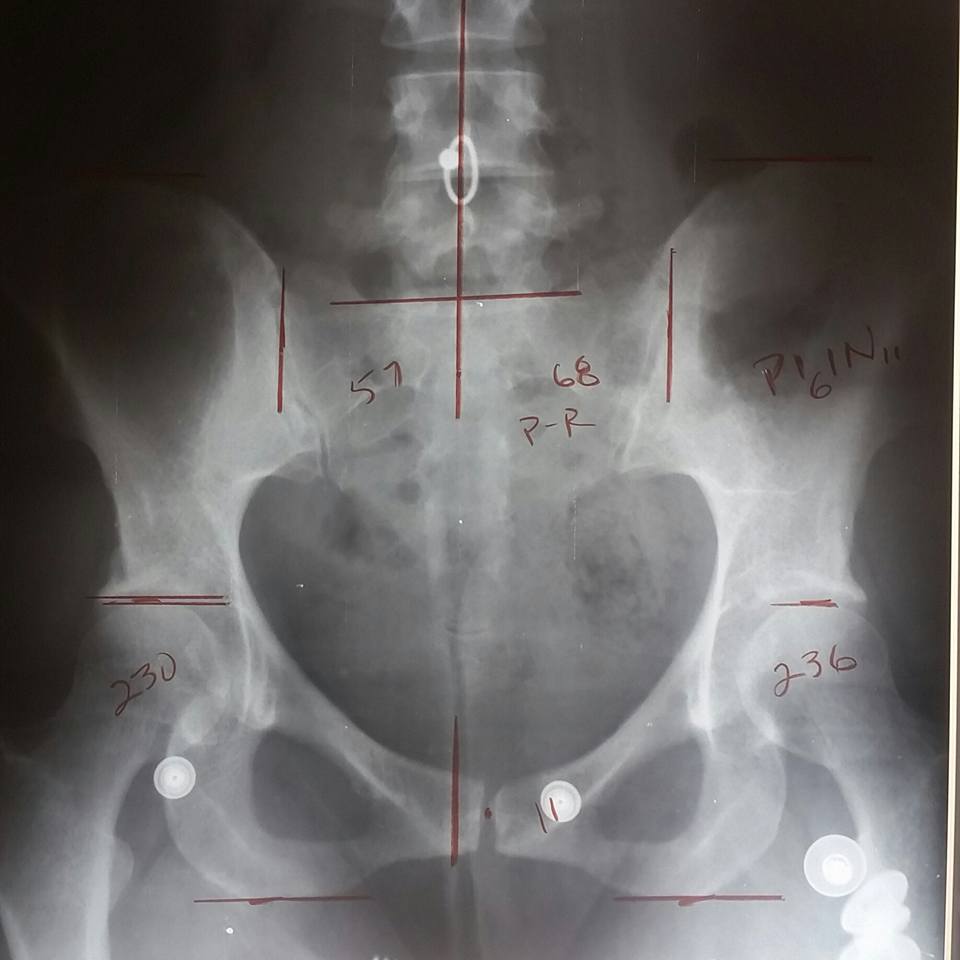 In this X-ray, you can see how far off center my pelvis wound up (11mm) after the accident. Real talk: it HURT!